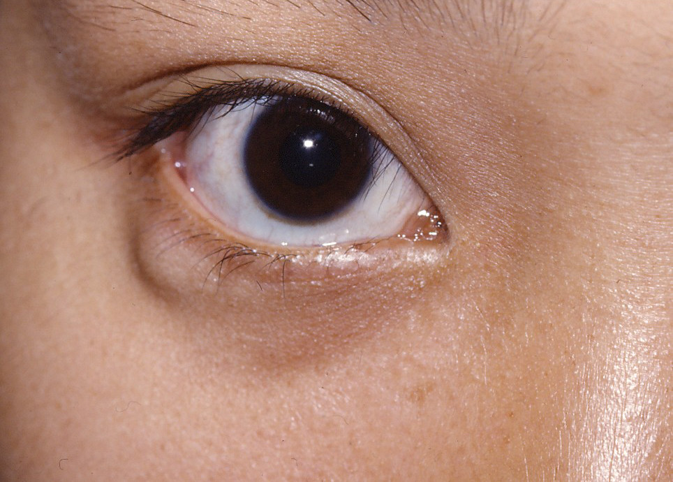 What to Expect During a Cyst on Eye Evaluation